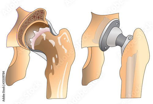 Vector: hip prosthesis hip prosthesis