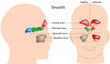 Sinusitis, eps8