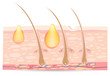 skin anatomy with acne