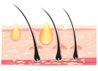 skin anatomy with acne