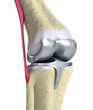 Knee and titanium hinge joint.  Isolated on white