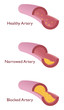 Vektor: atherosclerosis with three kind of vein atherosclerosis with three kind of vein
