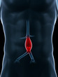 3d rendered medical illustration - aneurysm