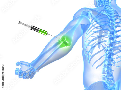 Illustration: 3d rendered illustration showing an elbow joint injection 3d rendered illustration showing an elbow joint injection