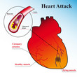 Heart attack