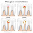 Periodontal Disease , eps8