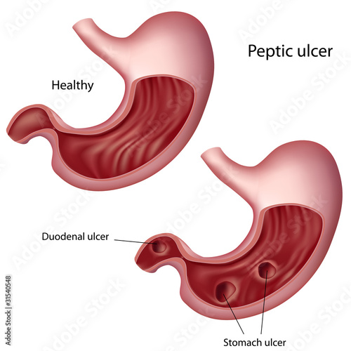 Vector: Stomach ulcer, eps8 Stomach ulcer, eps8