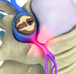 Prolapse of intervertebral disc closeup