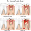 Tooth decay,eps8