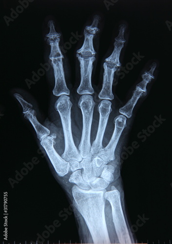 Photo: X-ray / Hand X-ray / Hand