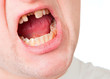 Young man face with broken tooth Young man face with broken tooth