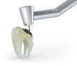 Treatment of a tooth with caries Treatment of a tooth with caries