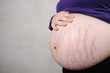 Pregnant woman with natural stomach - cracks on skin Pregnant woman with natural stomach - cracks on skin