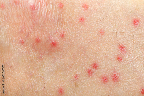 Photo: mosquito allergy on human skin mosquito allergy on human skin