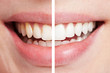 Zähne vor und nach dem Bleaching