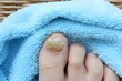 Nagelpilz, Fußpflege