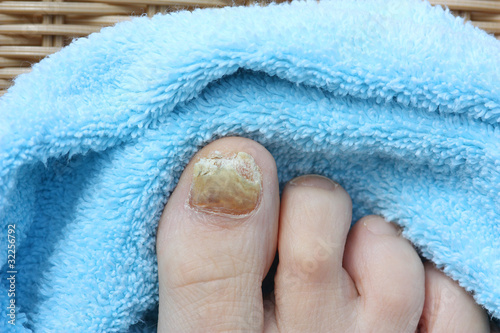 Foto: Nagelpilz, Fußpflege Nagelpilz, Fußpflege