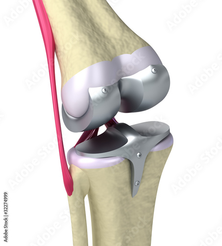 Illustration: Knee and titanium hinge joint. Isolated on white Knee and titanium hinge joint. Isolated on white