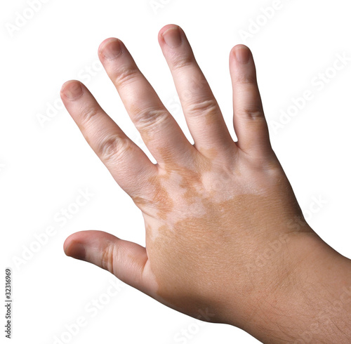 Photo: Vitiligo Vitiligo