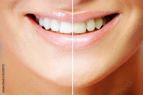 Foto: Teeth whitening , before and after comparison Teeth whitening , before and after comparison