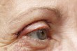 Eye plastic surgery