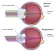 Astigmatism, a common eye defect, eps10