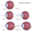 Myopia and hyperopia, eps8