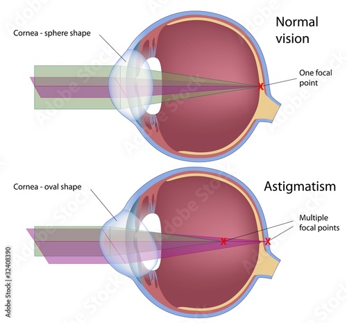 Vector: Astigmatism, a common eye defect, eps10 Astigmatism, a common eye defect, eps10