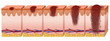 melanoma