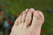 fuss mit nagelpilz