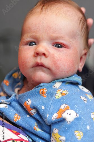 Photo: Infant has eczema Infant has eczema