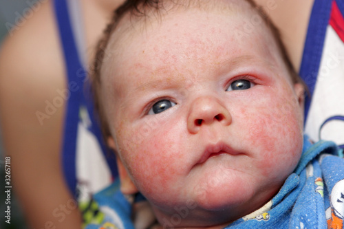 Photo: Newborn has eczema Newborn has eczema