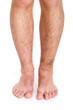 Ankle Sprain