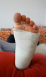 jambe plâtrée