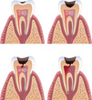Caries stages