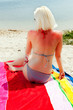 Foto: Junge Frau mit Sonnenbrand 502 sonnenbrand Junge Frau mit Sonnenbrand 502 sonnenbrand