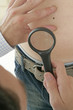 Dermatologie- grain de beauté suspect