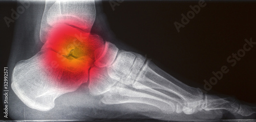 Photo: painful human right foot ankel xray picture (external side) painful human right foot ankel xray picture (external side)