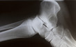 human foot ankle closeup xray
