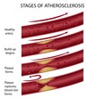 Stages of atherosclerosis, eps8 Stages of atherosclerosis, eps8