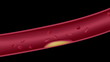 Atherosclerosis: Cholesterol plaque in artery