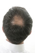 Photo: Tonsure-perte de cheveux Tonsure-perte de cheveux