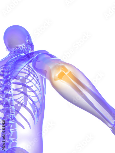 Illustration: 3d rendered medical illustration of a bursitis 3d rendered medical illustration of a bursitis