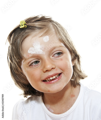 Photo: ill little girl - smallpox ill little girl - smallpox