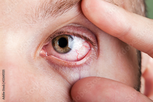 Foto: Blood capillary human eye Blood capillary human eye