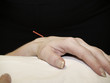 Acupuncture Concept