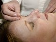 Acupuncture Concept