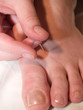 Acupuncture Concept