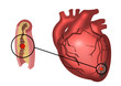 Infarto