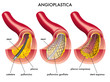 Angioplastica